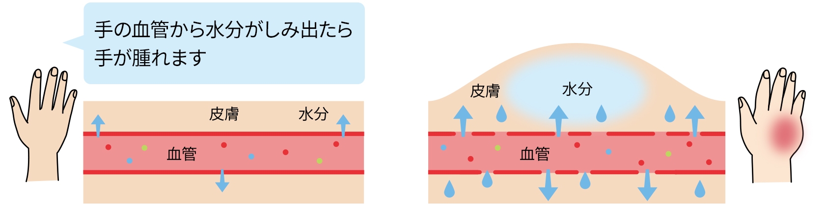 手の血管から水がしみ出たら手が腫れます