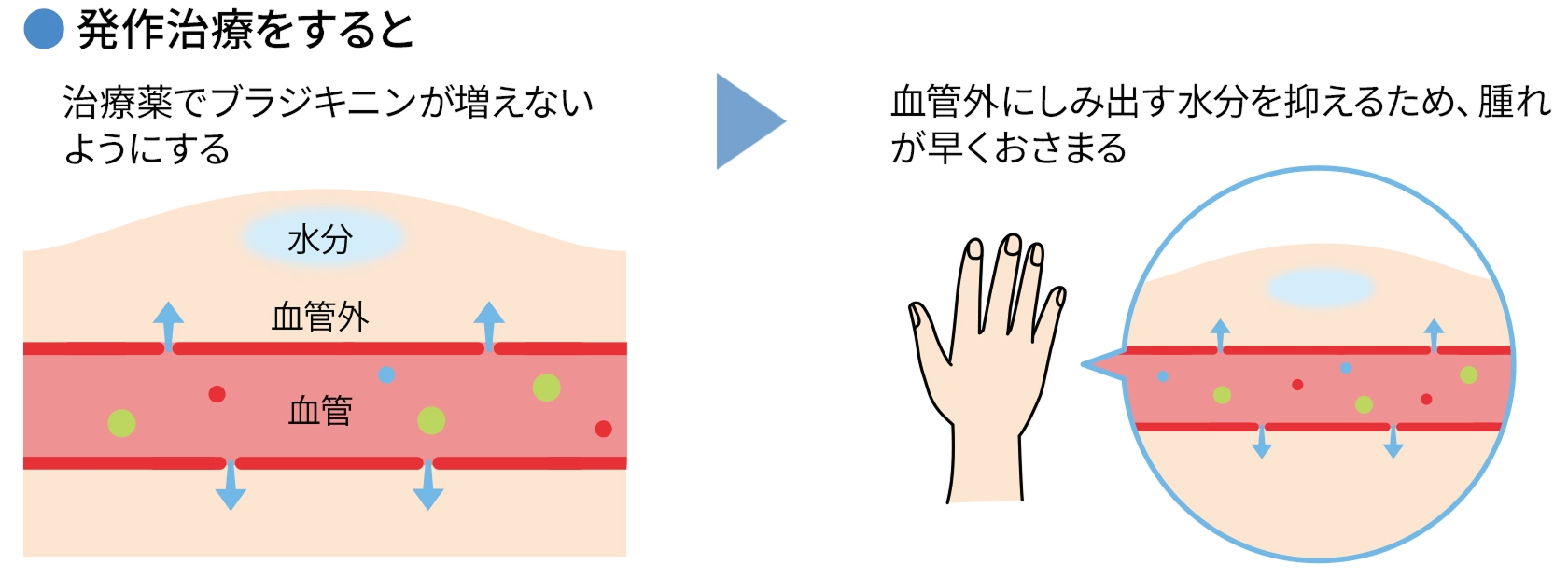 発作治療をした時の血管と症状を表した図