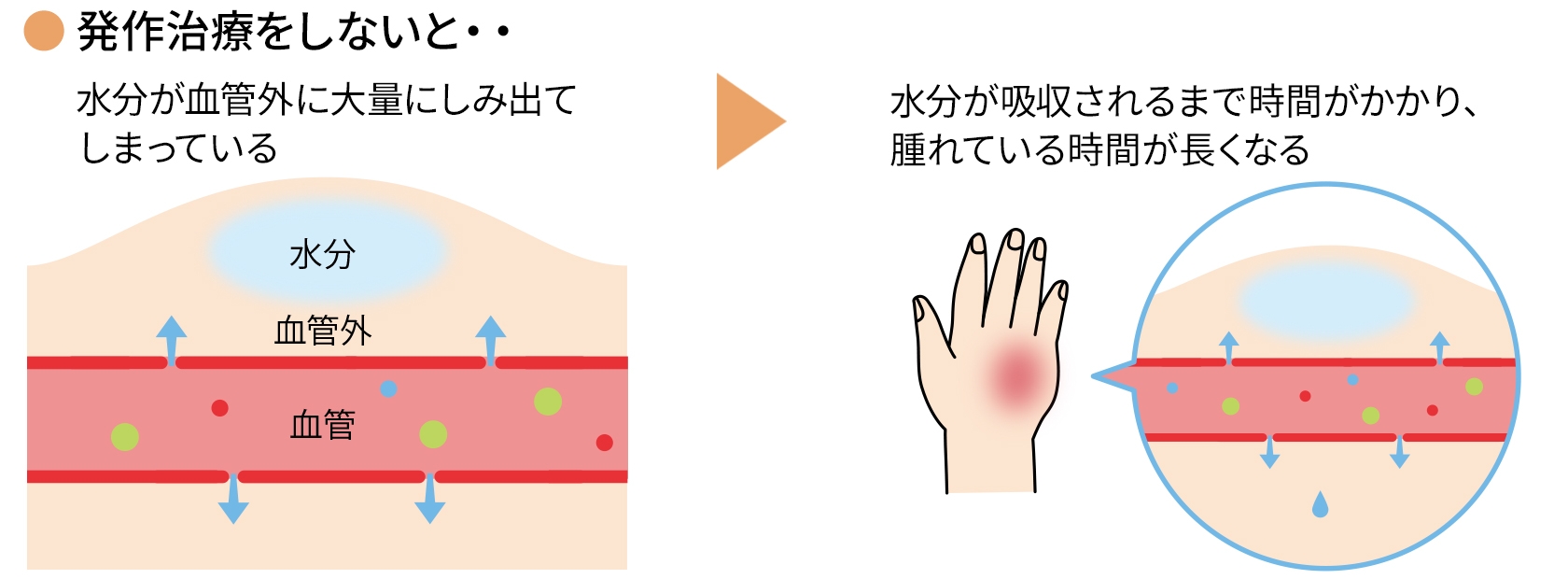 発作治療をしなかった時の血管と症状を表した図